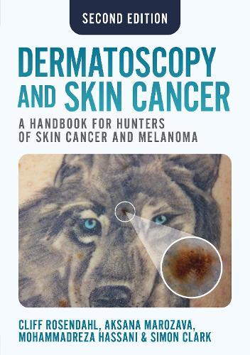Dermatoscopy and Skin Cancer, second edition: A handbook for hunters of skin cancer and melanoma  by Cliff Rosendahl at Abbey's Bookshop, 